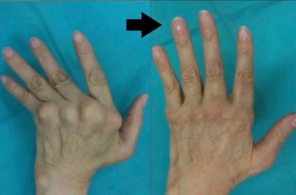 rheumatical2